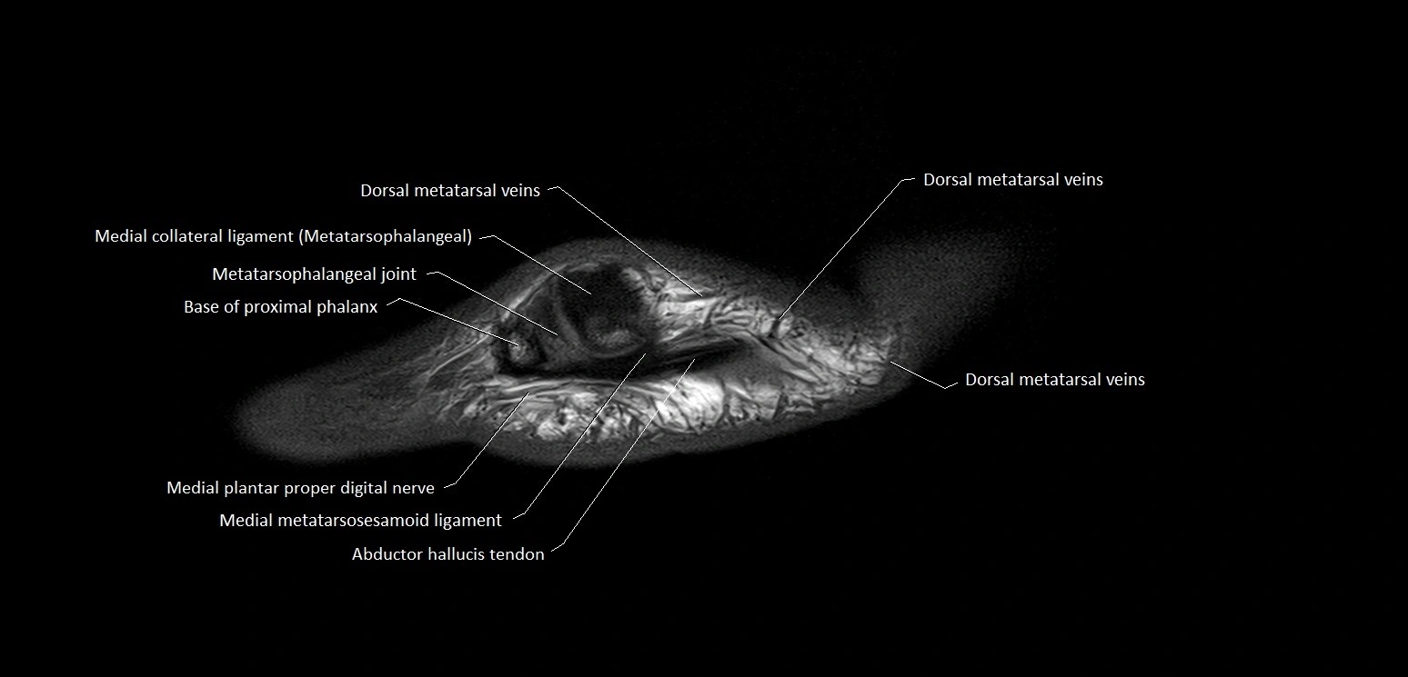 Hallux or big toe sagittal anatomy 3T MRI image 4.webp